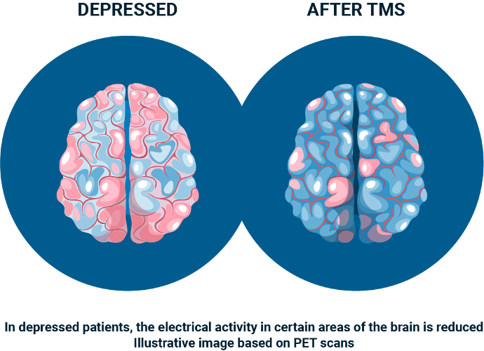 Ilustración: ejemplo de cambio en la actividad eléctrica cerebral tras TMS en depresión
